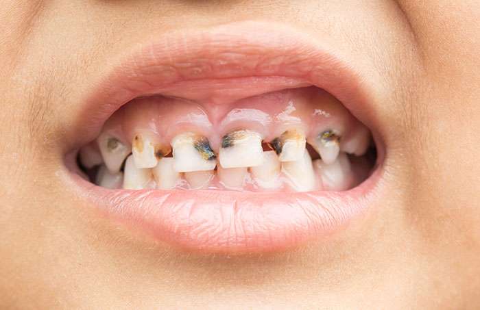 Why Senior Citizens Get Cavities
